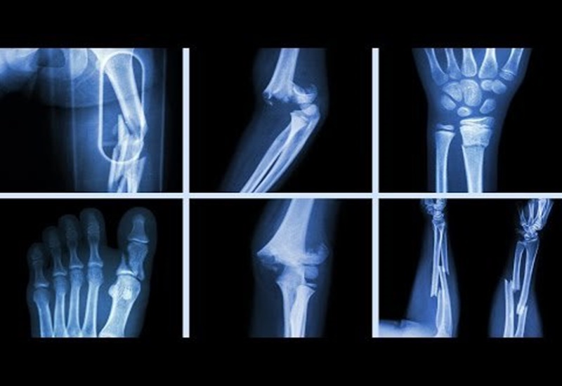 Gãy xương lâu lành do đâu?