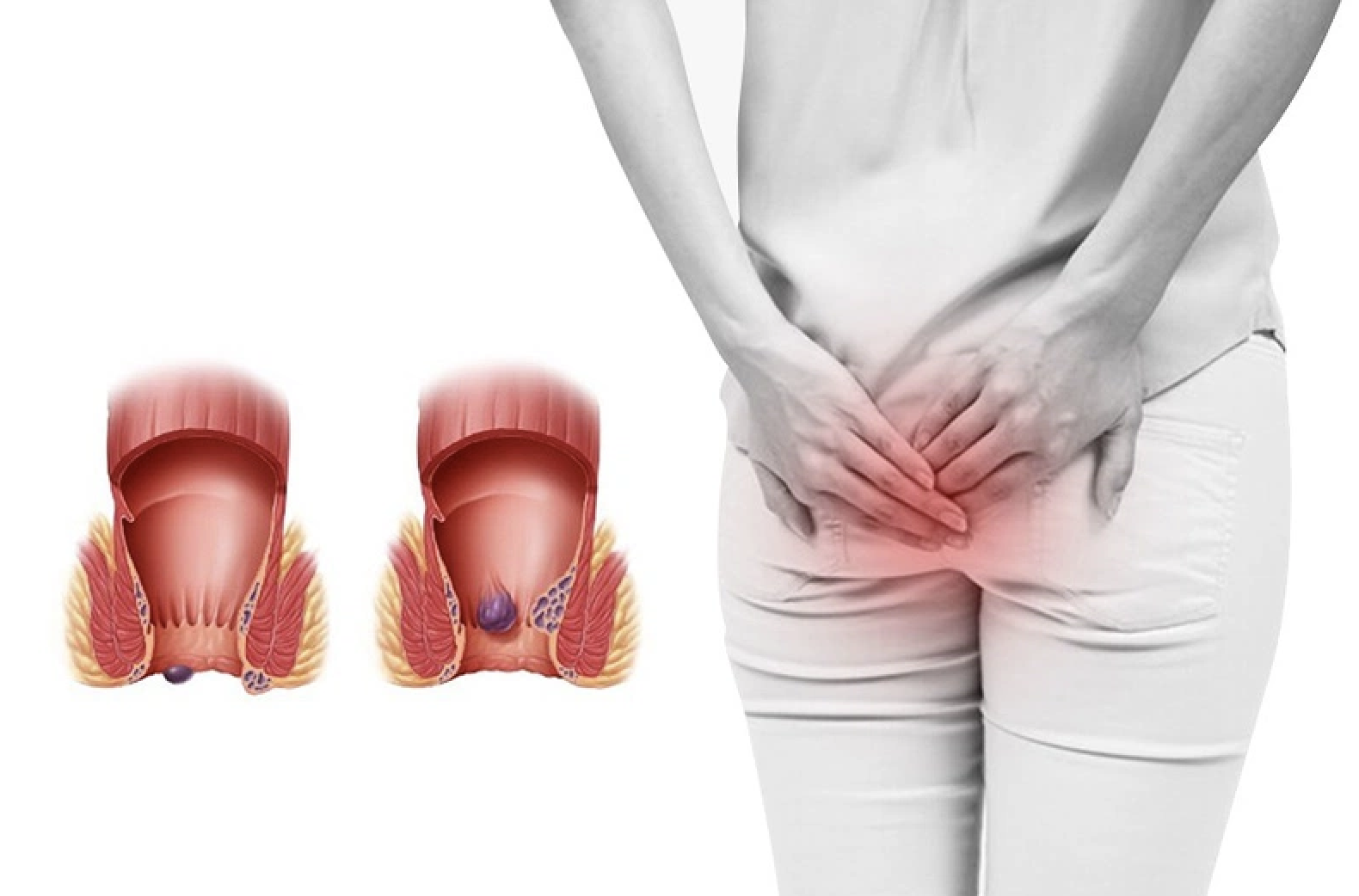 Mẹ sau sinh mệt mỏi, cảm thấy đau rát vùng hậu môn do bị trĩ sau sinh