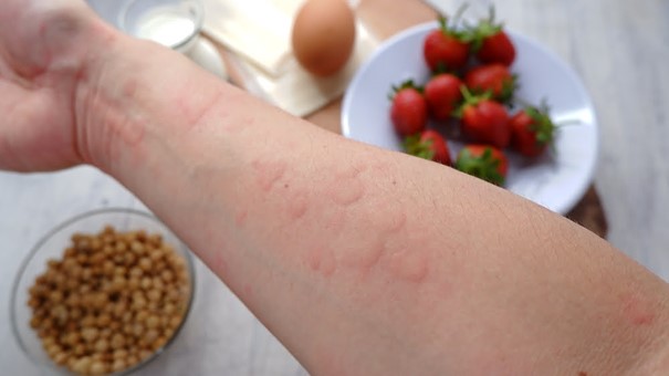 Dị ứng ngoài da thường gây ngứa rõ và dễ liên quan đến thuốc, thực phẩm hoặc yếu tố tiếp xúc