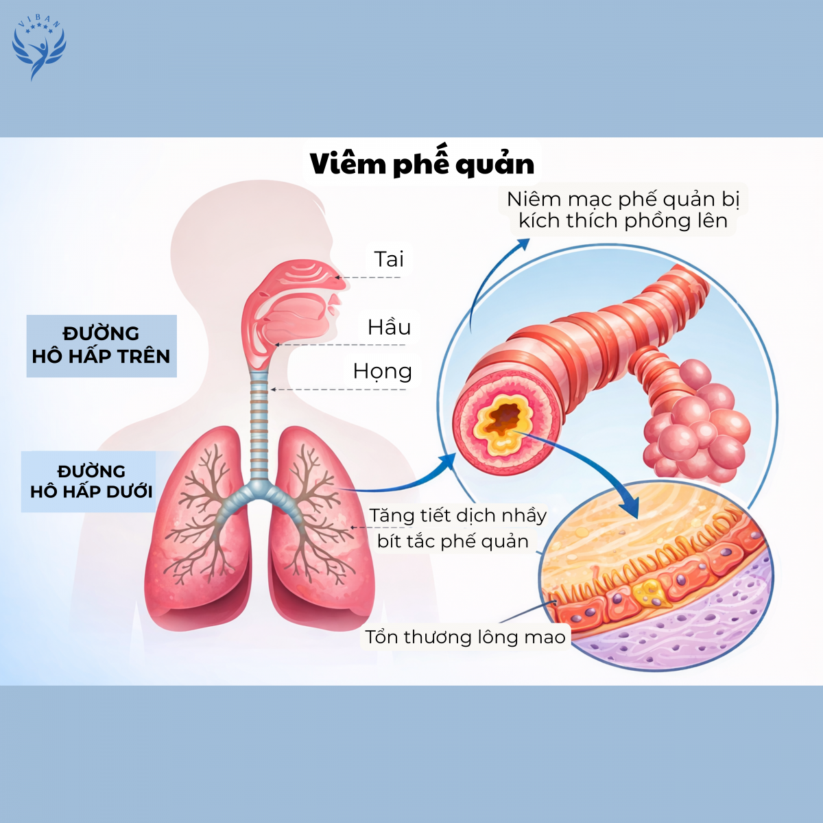 Viêm phế quản ở trẻ em gây ho nhiều, ho có đờm và khò khè